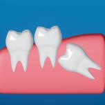Dente del giudizio orizzontale
