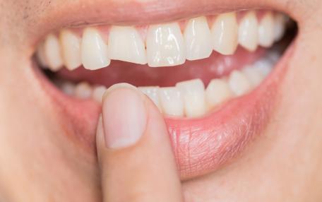 Avulsione dentale