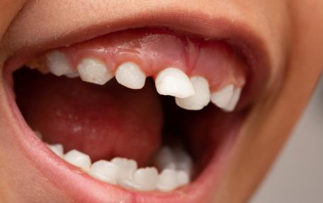 Denti che si muovono con la lingua