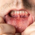 Pus dente
